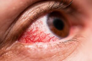 Conjunctivitis (pink eyes) treatment, causes, symptoms